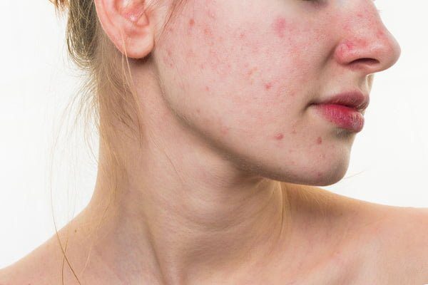 rosacea là gì