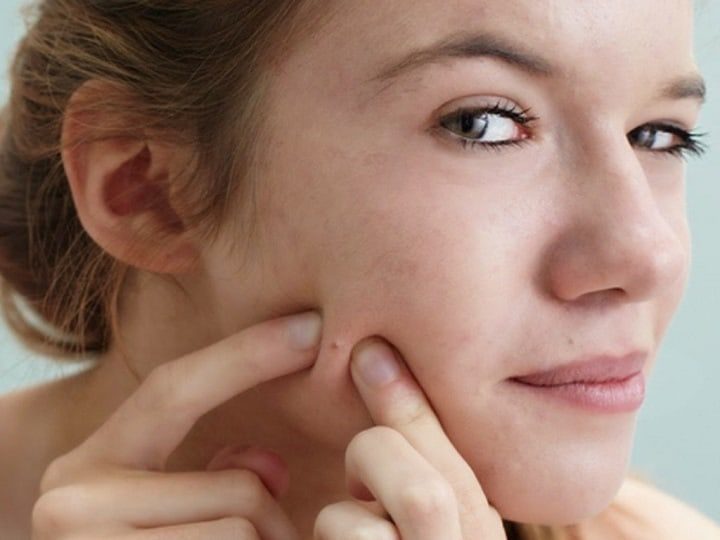 sản phẩm chăm sóc hỗ trợ giảm mụn Obagi