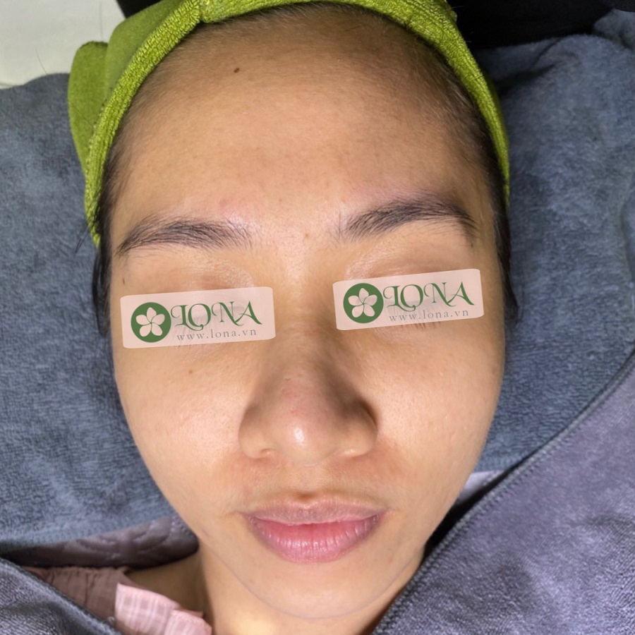 vitamin b5 hỗ trợ giảm mụn