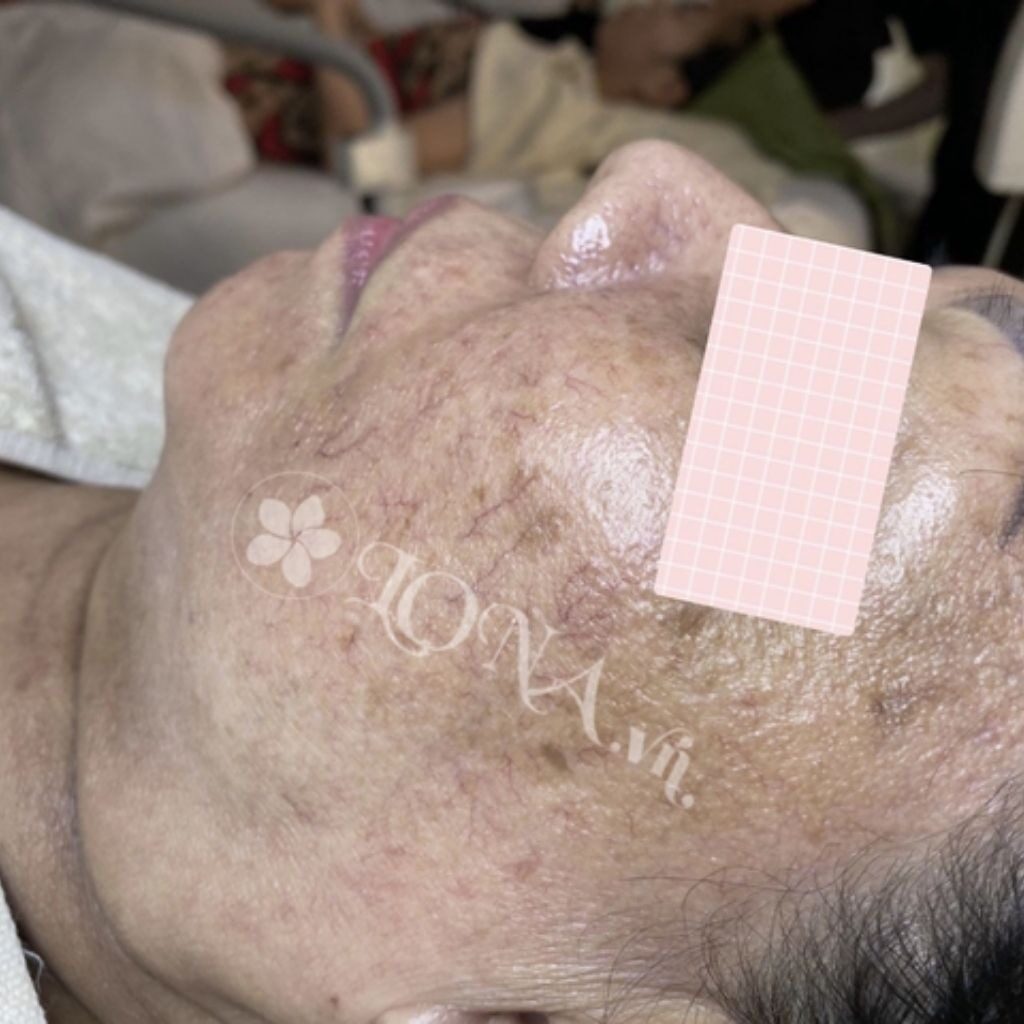 Cơ chế hoạt động của tretinoin giải quyết các vấn đề lão hóa da