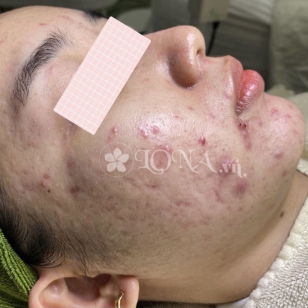 Tretinoin kết hợp BHA/AHA điều trị mụn
