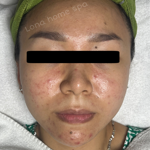 Khả năng kích ứng trên da khi dùng kojic acid