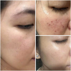 Điều trị sẹo rỗ