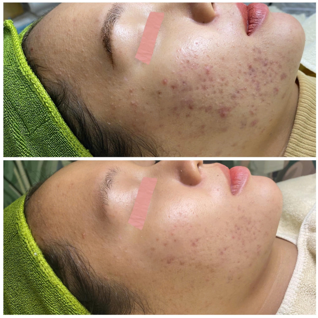 Kết quả điều trị tăng sắc tố sau viêm