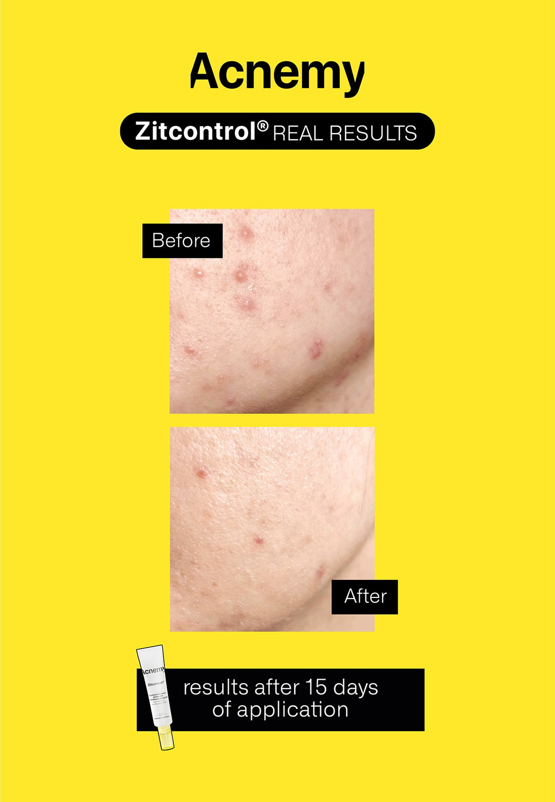 niacinamide hỗ trợ giảm mụn