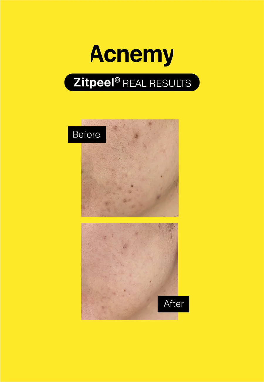 Zitpeel®