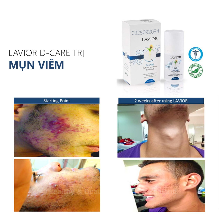 LAVIOR D-CARE trị mụn viêm hiệu quả