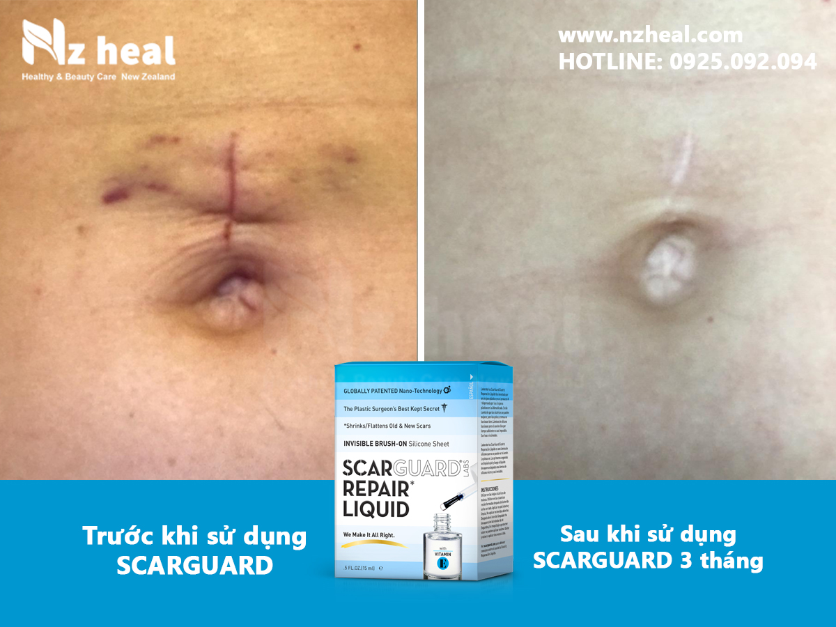 Gel trị sẹo lồi Scarguard Repair Liquid 15ml co tốt không?
