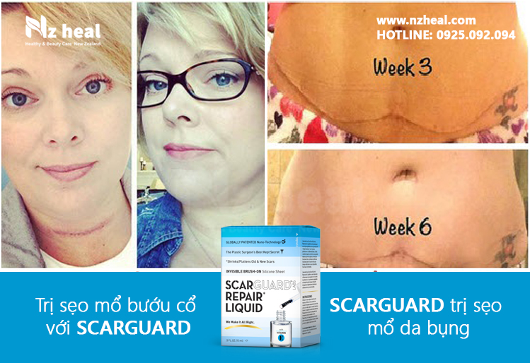 Review gel trị sẹo lồi Scarguard Repair Liquid 15ml