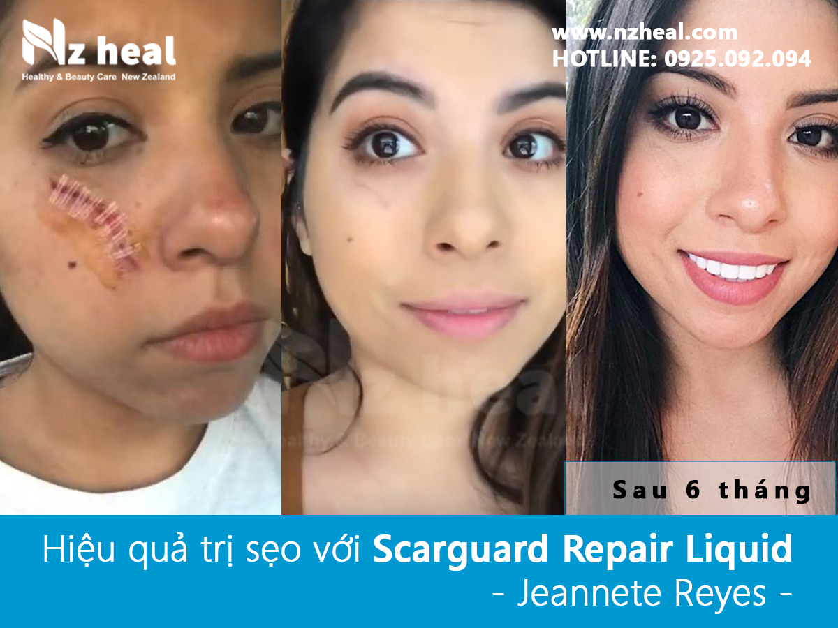 Trị sẹo lồi với gel Scarguard Repair Liquid