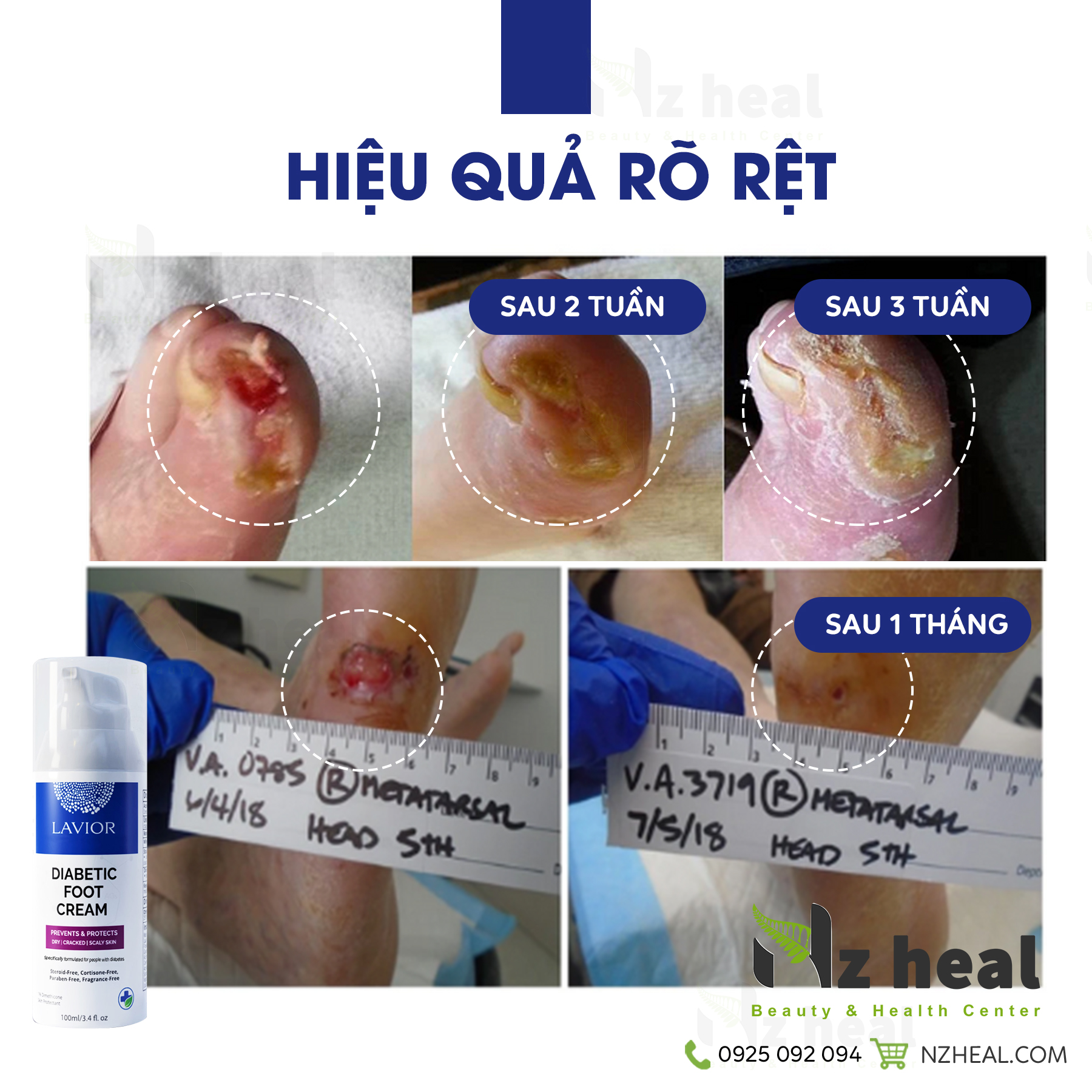 Kem dưỡng chống loét tì đè LAVIOR Diabetic Foot Cream 100ml 1