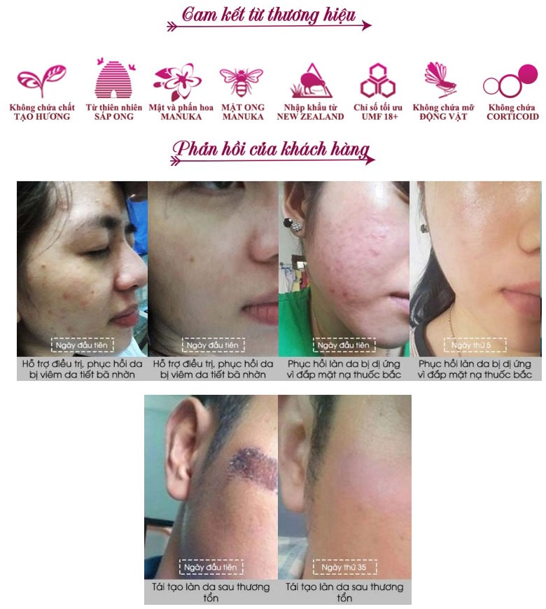 Kem Mật Ong Manuka Skin Health 18+ Madeleine Ritchie 40ml 1