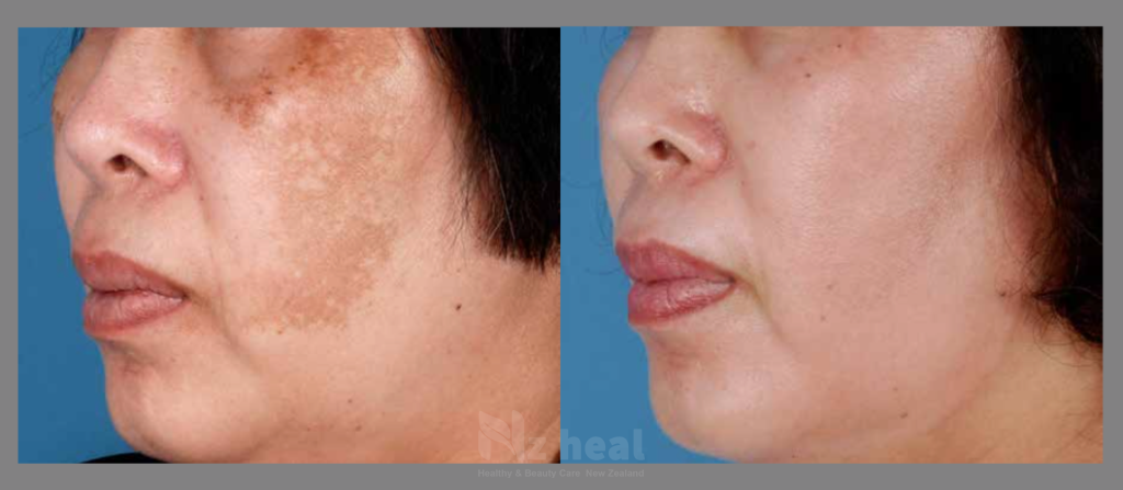 Hiệu quả của serum trị nám, thâm da Scarguard Lightening Serum