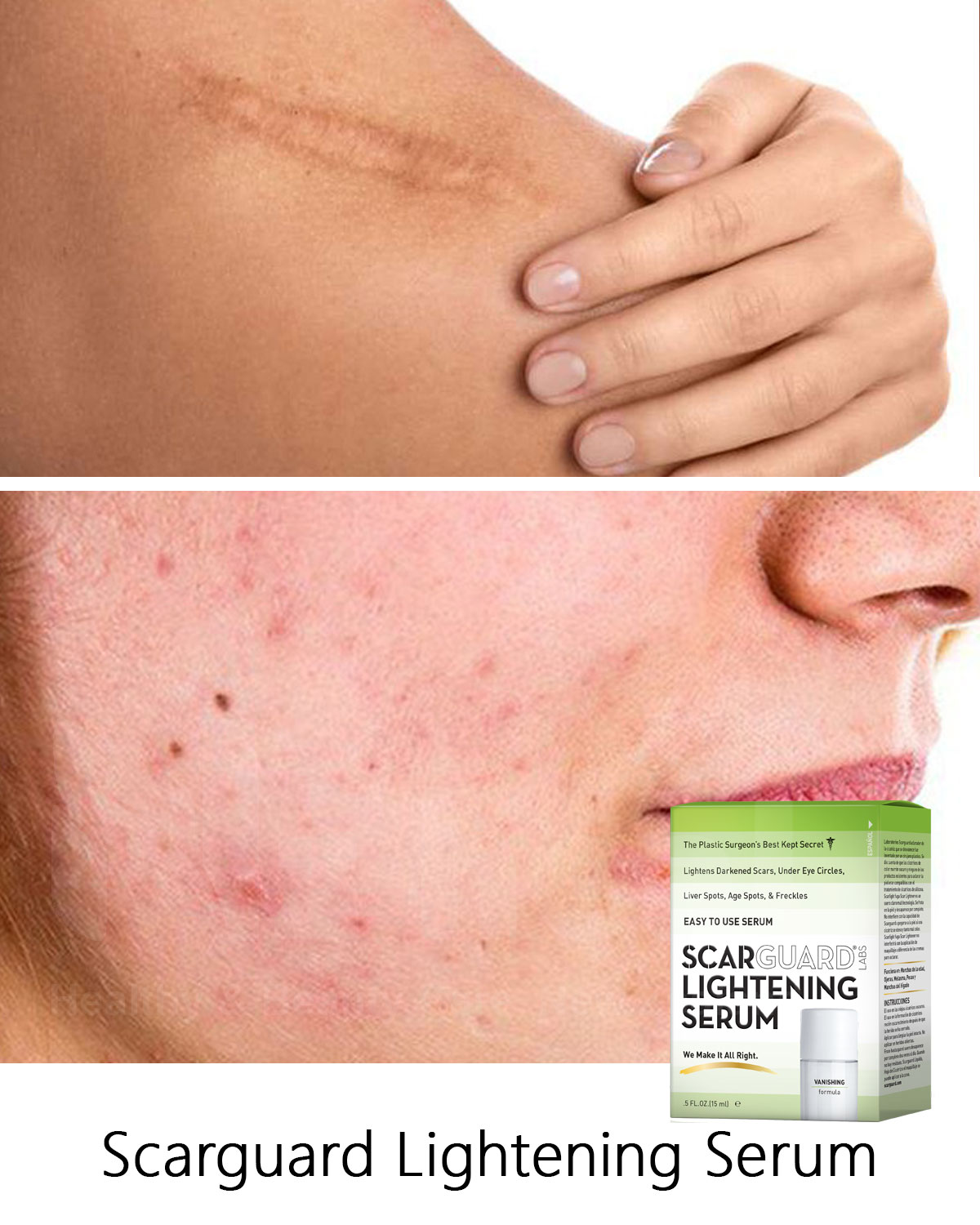 Scarguard Lightening Serum trị sẹo thâm mụn