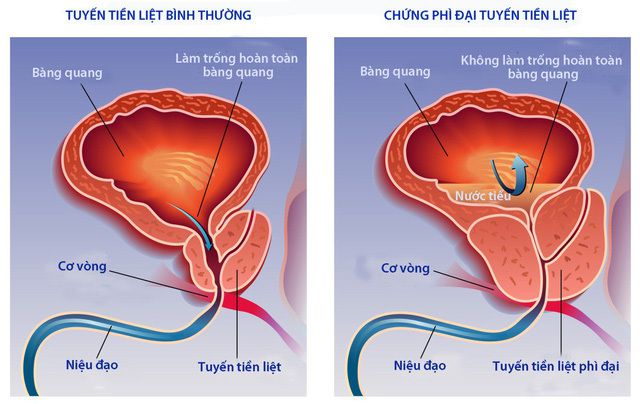 Phì đại tuyến tiền liệt