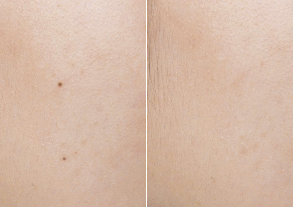 Hình ảnh cho thấy BHA OBAGI (TONER CHỨA 2% BHA OBAGI CLENZIDERM M.D. EXFOLIATING) và BHA Obagi mẫu mới 2025 hỗ trợ giảm bã nhờn, giúp lỗ chân lông thông thoáng.