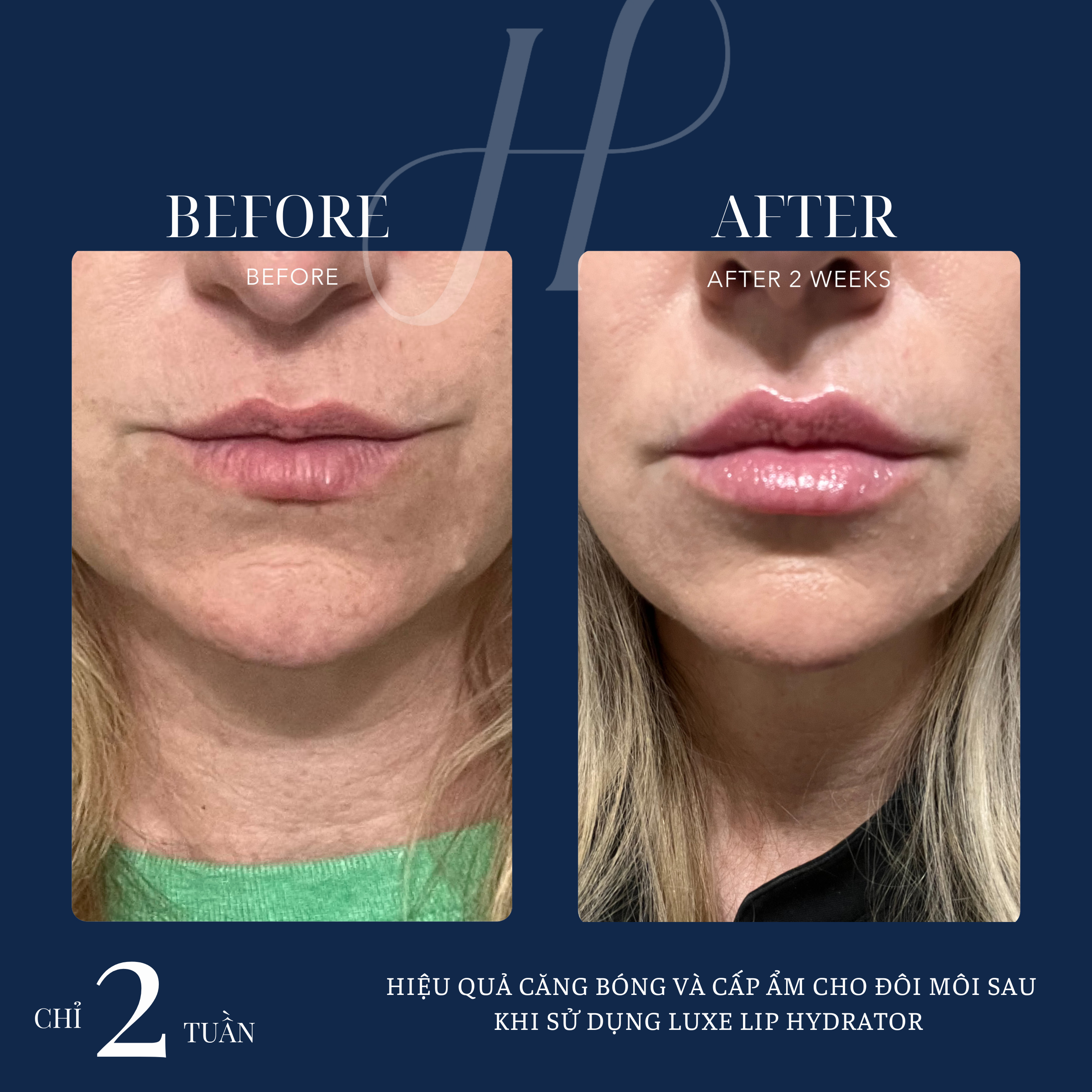 Hydrinity Luxe Lip Hydrator - ảnh minh hoạ trước điều trị