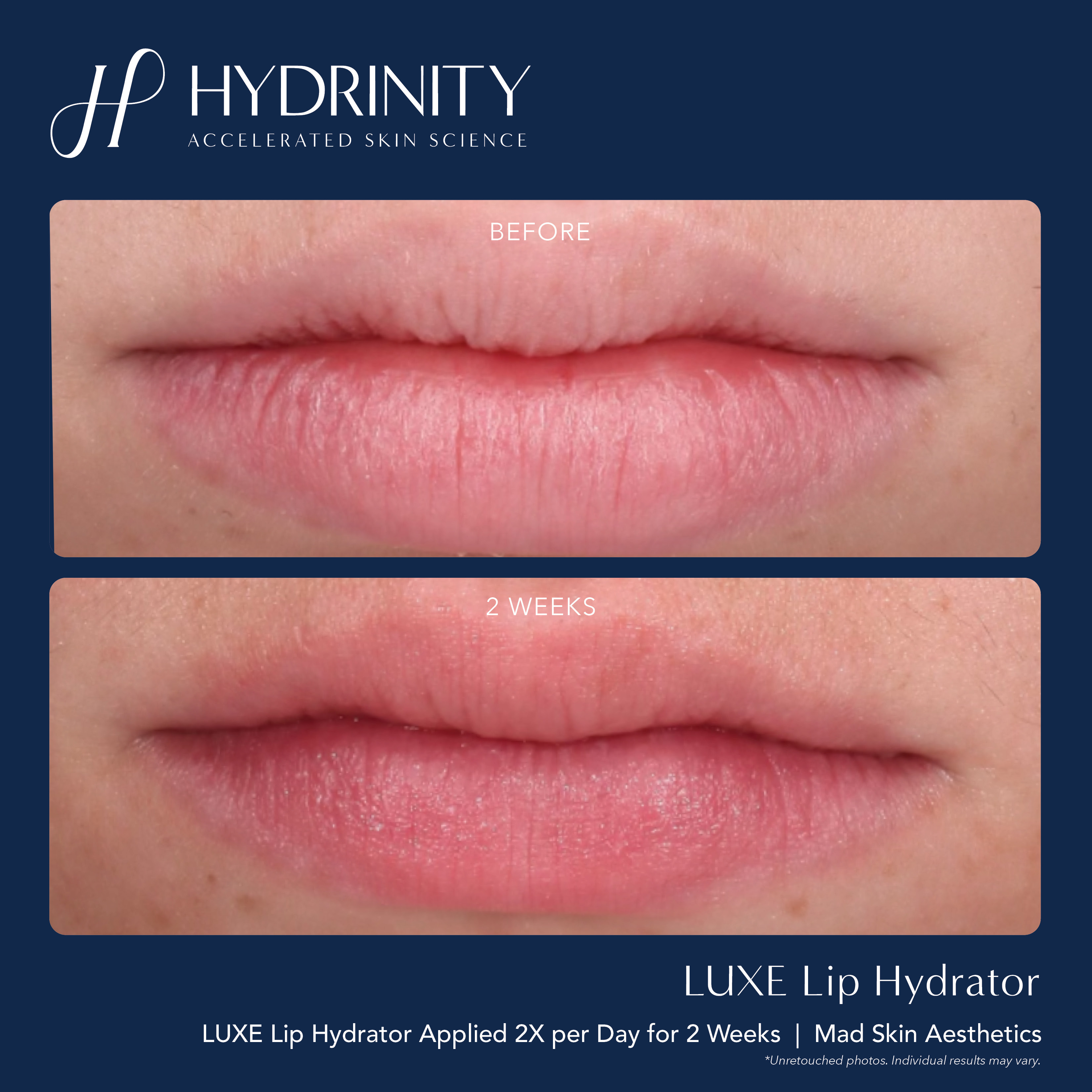 Hydrinity Luxe Lip Hydrator - hình trước sau sử dụng sản phẩm