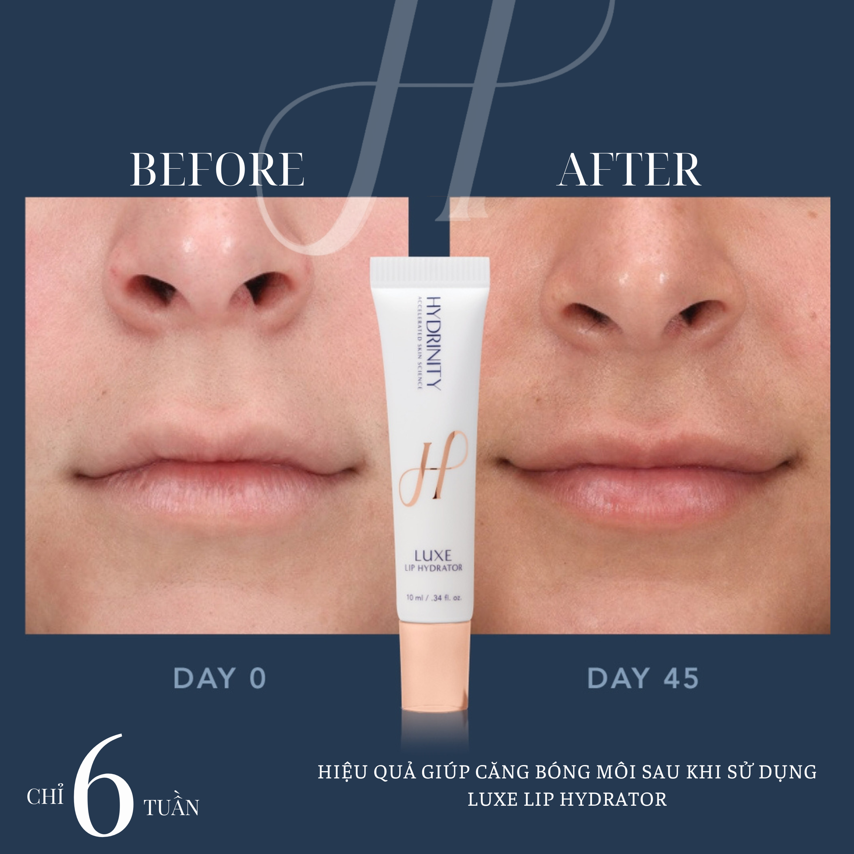 Hydrinity Luxe Lip Hydrator - kết quả sau 6 tuần