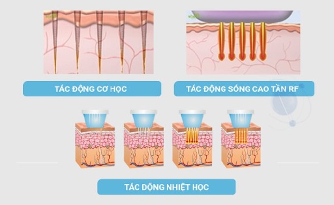 Công nghệ RF vi điểm – nền tảng cốt lõi của FACETEM