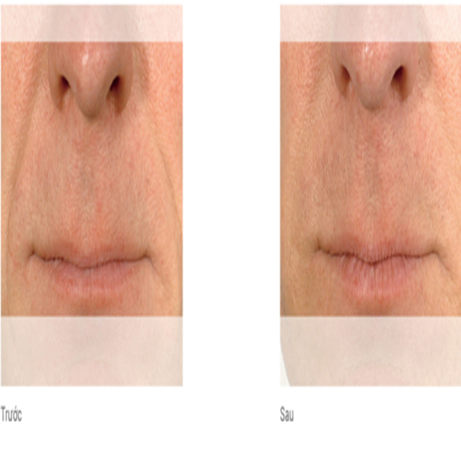 BELOTERO® - MERZ AESTHETICS chính hãng