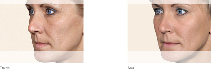 Khôi phục thể tích vùng má bằng Belotero® Volume