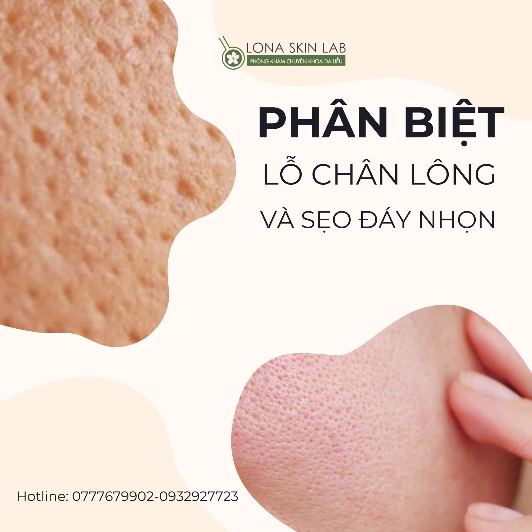 PHÂN BIỆT LỖ CHÂN LÔNG TO VÀ SẸO ĐÁY NHỌN?