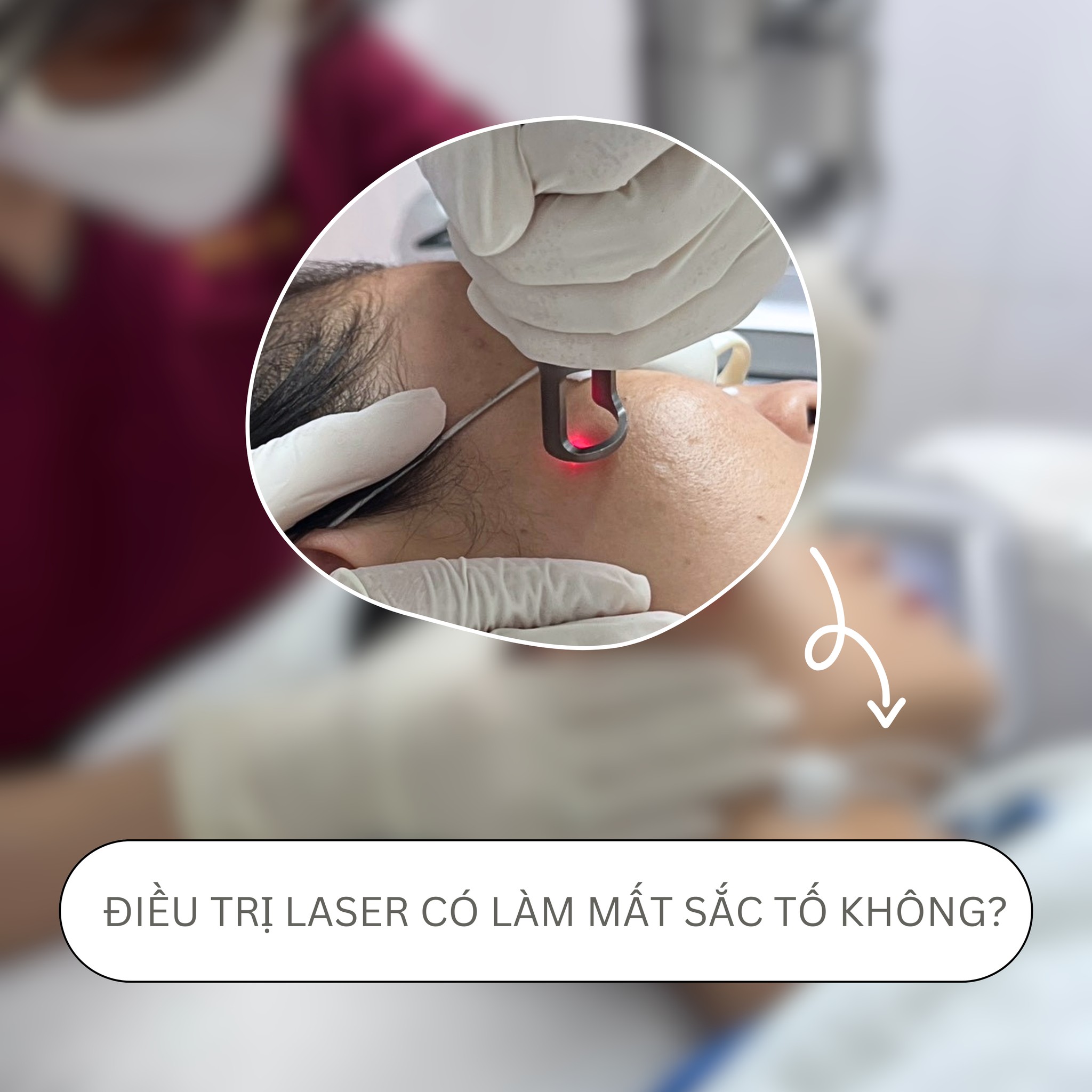 Trị mất sắc tố da – Hướng dẫn điều trị laser