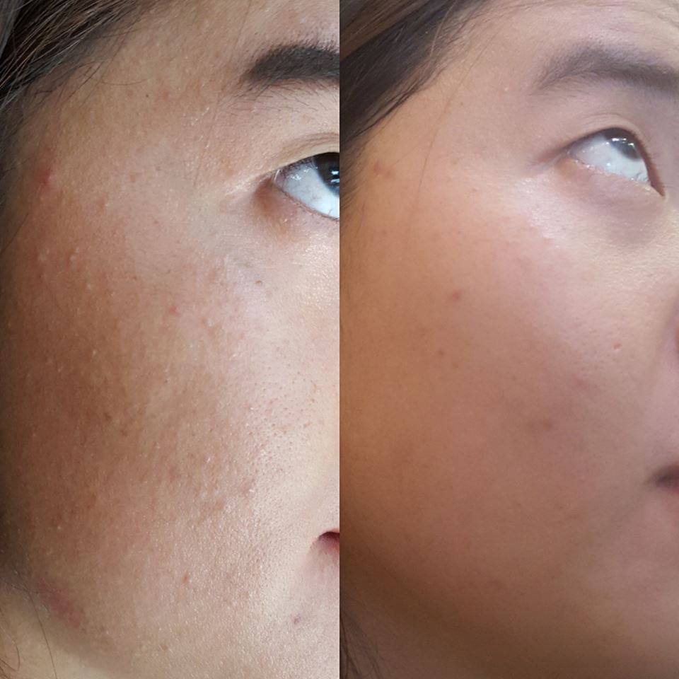GIÃN MAO MẠCH: CÓ THỂ ĐIỀU TRỊ DỨT ĐIỂM?