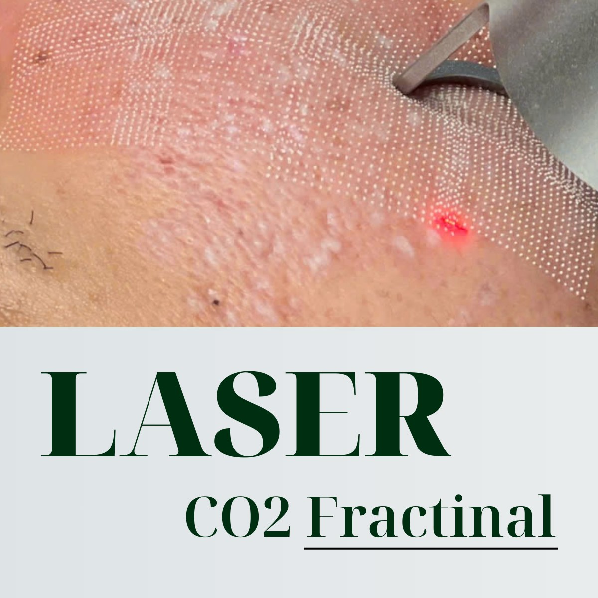 LASER CO2 FRACTIONAL - ĐIỀU TRỊ SẸO CHÂN ĐINH