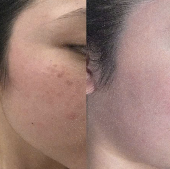 Tại Sao Chỉ Có máy YAG Đạt Tiêu Chuẩn Để Điều Trị Bớt Hori?