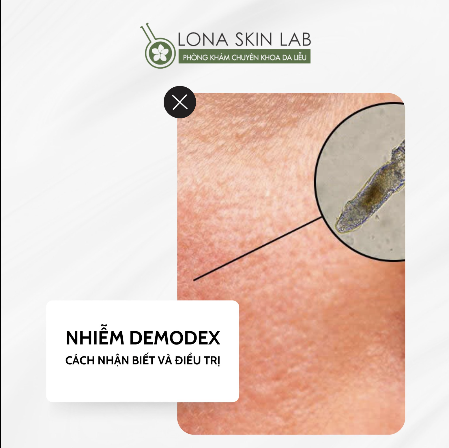NHIỄM DEMODEX: CÁCH NHẬN BIẾT VÀ ĐIỀU TRỊ?