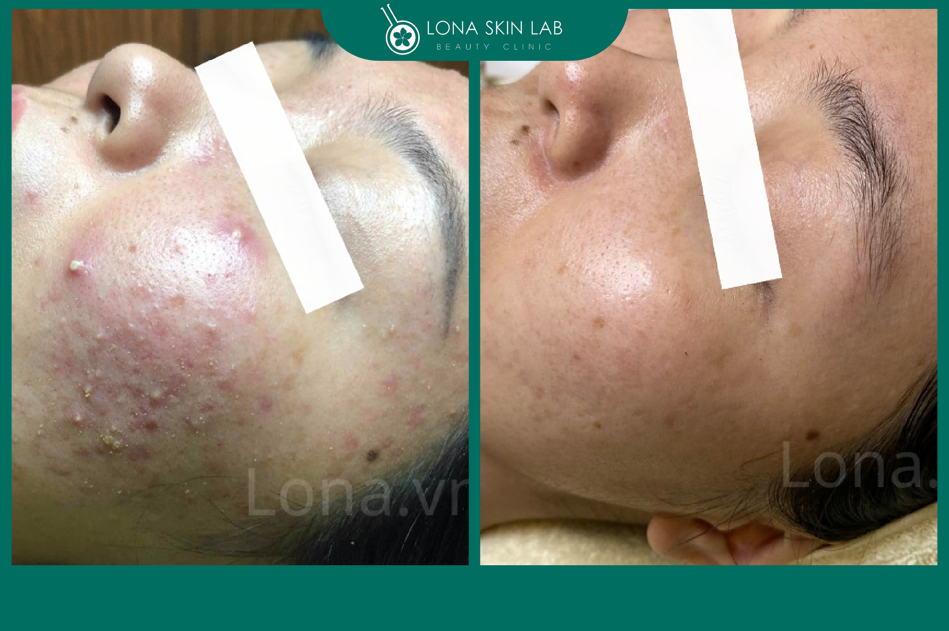 LẤY NHÂN MỤN CÓ NÊN HAY KHÔNG TRONG ĐIỀU TRỊ MỤN?