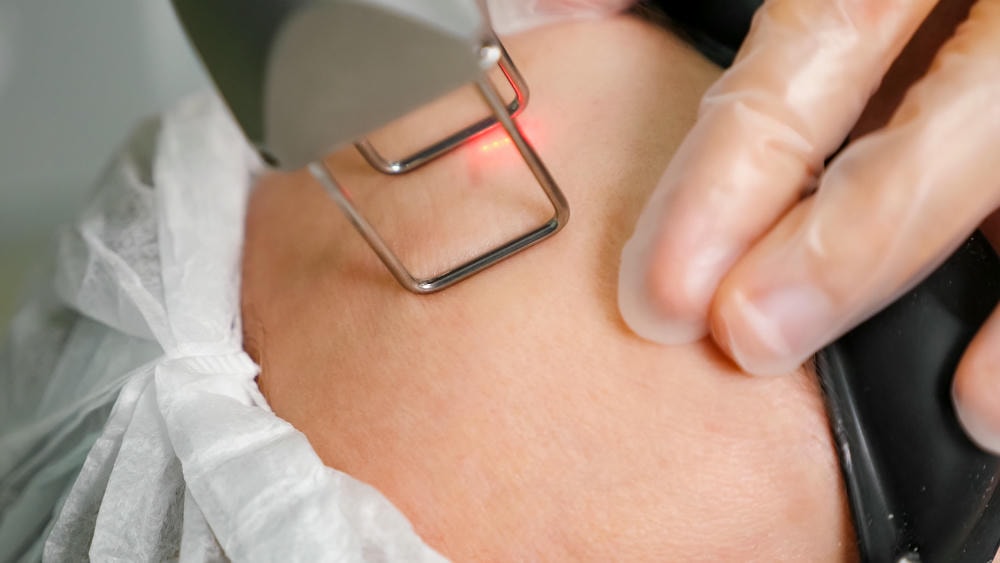 bắn laser trị sẹo. Bàn tay phụ nữ thực hiện quy trình trẻ hóa bằng laser trên trán người phụ nữ, đeo kính bảo hộ và mũ trùm tóc trắng, nhìn gần