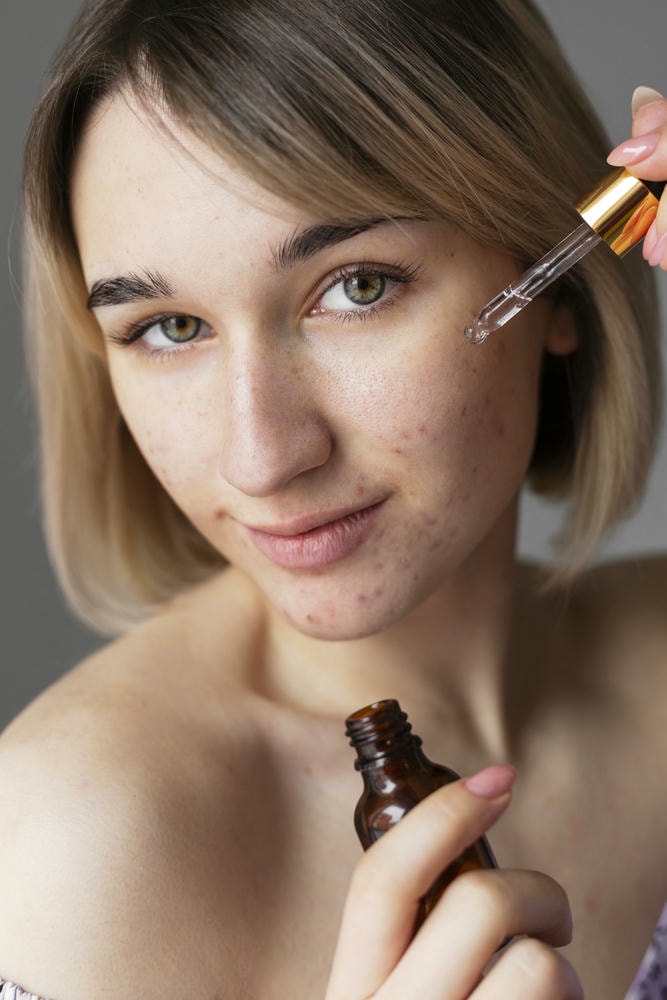 Hình ảnh cảnh báo về tác dụng phụ của Benzoyl Peroxide khi không sử dụng đúng cách, giúp nhận biết tác dụng phụ của Benzoyl Peroxide để điều chỉnh liệu trình phù hợp.