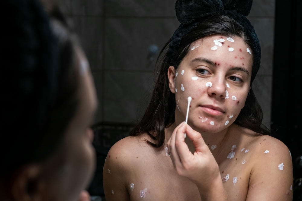 Benzoyl Peroxide là thành phần chủ đạo trong các sản phẩm điều trị mụn, giúp làm sạch sâu lỗ chân lông và giảm hiện tượng viêm nhờ vào đặc tính kháng khuẩn của Benzoyl Peroxide.
