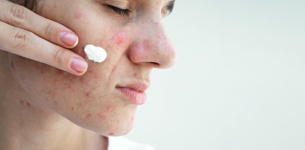 Sản phẩm trị mụn chứa benzoyl peroxide không chỉ đảm bảo trị mụn hiệu quả mà còn được đánh giá sản phẩm trị mụn hiệu quả và trở thành sản phẩm trị mụn tốt nhất khi tích hợp serum trị mụn trong liệu trình điều trị.