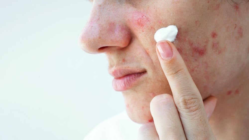 Trong lĩnh vực điều trị mụn, benzoyl cùng Benzoyl Peroxide được chuyên gia da liễu Lona khuyến nghị vì khả năng giảm mụn vượt trội, song cần cân nhắc tác dụng phụ Benzoyl Peroxide khi kết hợp BHA và Benzoyl Peroxide.