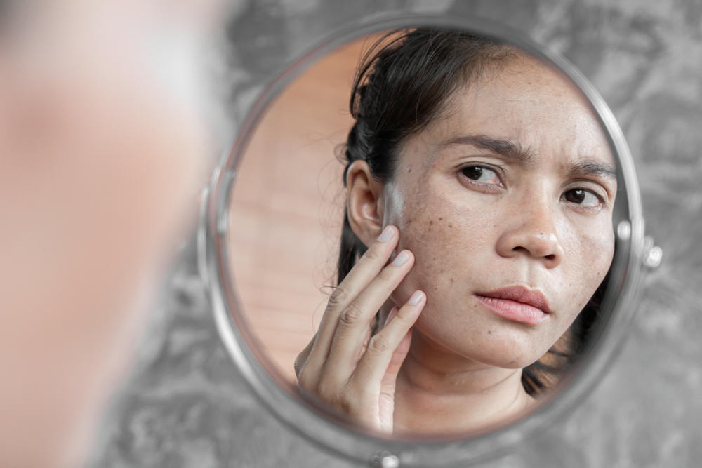 Áp dụng quy trình Điều trị bớt Hori bằng phương pháp trị bớt Hori hiện đại, chuyên gia da liễu bớt Hori đã chứng minh hiệu quả trị bớt Hori vượt trội, biến bớt hori thành một tiêu chuẩn Bớt Hori thẩm mỹ tối ưu.