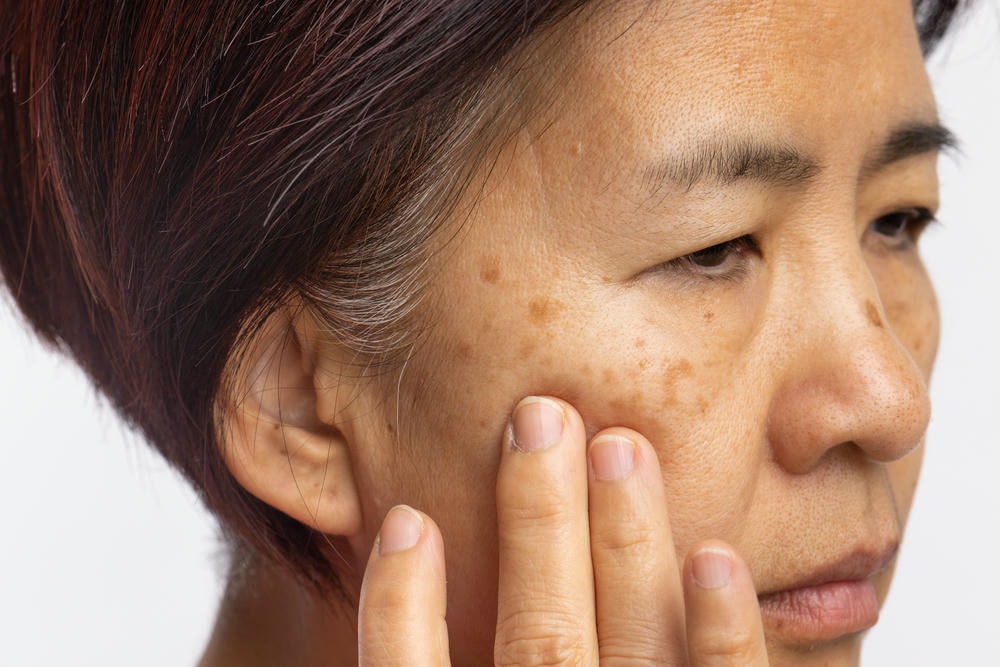 Sử dụng phương pháp trị bớt Hori mới, chuyên gia da liễu bớt Hori hướng dẫn bệnh nhân áp dụng Điều trị bớt Hori một cách khoa học, giúp nâng cao hiệu quả trị bớt Hori và đạt chuẩn Bớt Hori thẩm mỹ trong việc bớt hori.