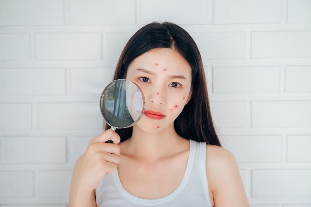 Ảnh này mô tả trực quan các bước chăm sóc da mụn, là minh chứng cho chuyên gia da liễu thẩm mỹ Lona trong việc hướng dẫn chăm sóc da mụn tại nhà và thực hiện các bước chăm sóc da mụn hiệu quả qua từng bước chăm sóc da mụn.