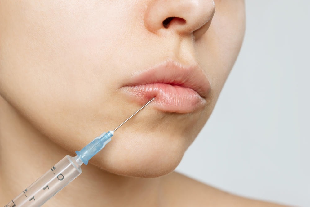 Qua phân tích dáng môi chuyên sâu, các dáng môi của bệnh nhân được tái hiện tự nhiên sau khi tiêm filler môi, khi các loại filler tiên tiến được lựa chọn filler để cân bằng dáng môi hài hòa.