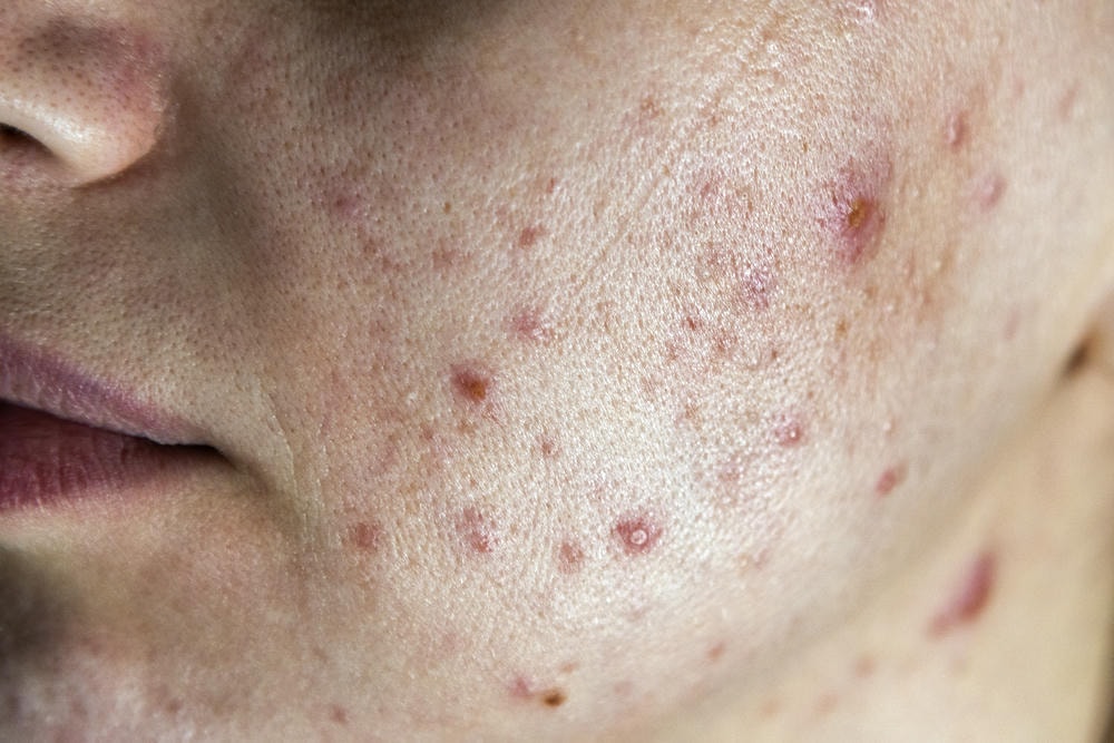 các loại mụn ở mặt. Cận cảnh khuôn mặt phụ nữ với làn da xấu và mụn đỏ.
