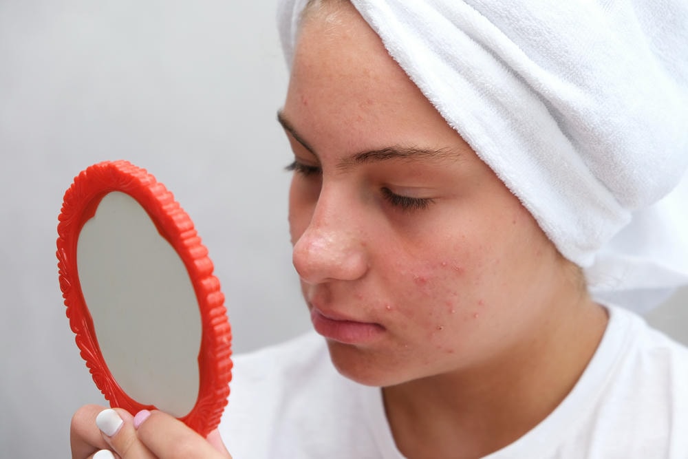 cách để hết mụn. Một cô gái tuổi teen buồn bã đang nhìn những nốt mụn trên mặt trong gương. Da có vấn đề ở tuổi vị thành niên. Mụn trứng cá.