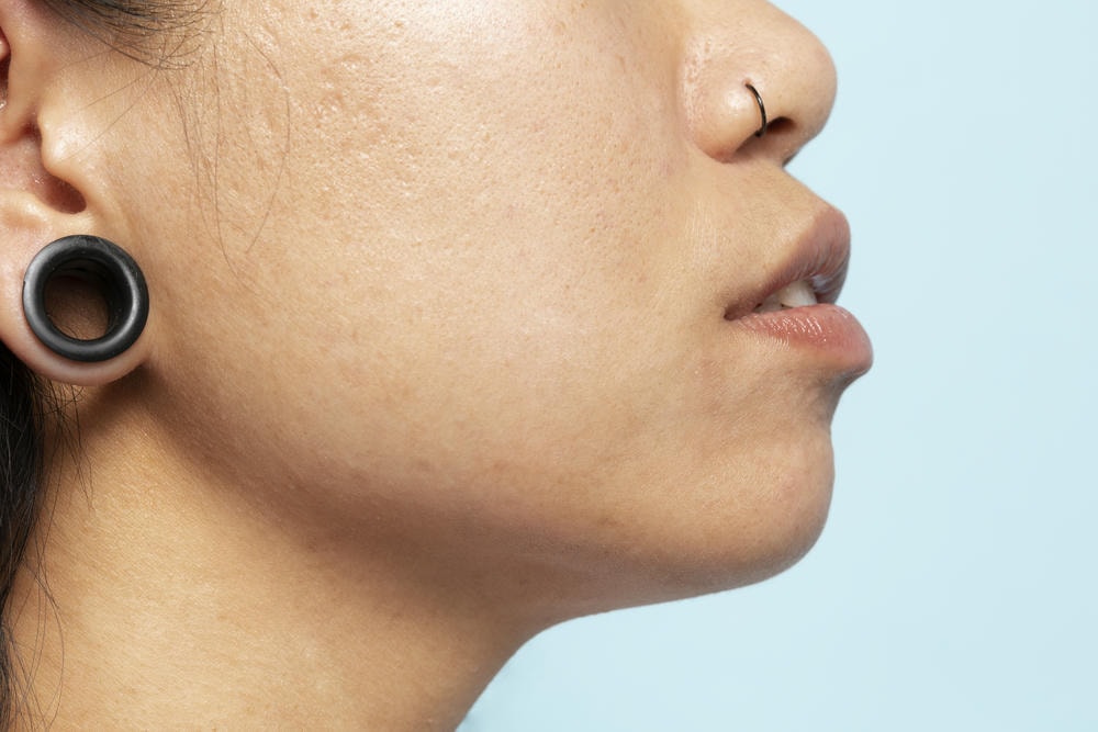 cách thu nhỏ lỗ chân lông. Ảnh ghép với ảnh một người bị mụn trứng cá trước và sau khi điều trị cận cảnh Thiết kế biểu ngữ hiển thị làn da bị ảnh hưởng và khỏe mạnh