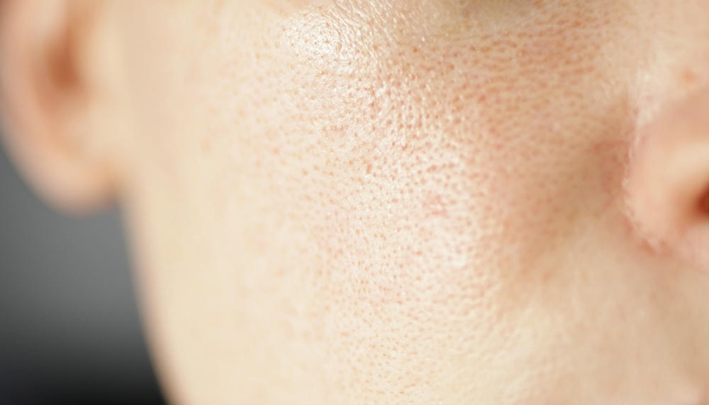 cách thu nhỏ lỗ chân lông. Kết cấu kin, không khỏe mạnh với lỗ chân lông to và bệnh rosacea, phát ban đỏ. Dị ứng và mẩn đỏ.