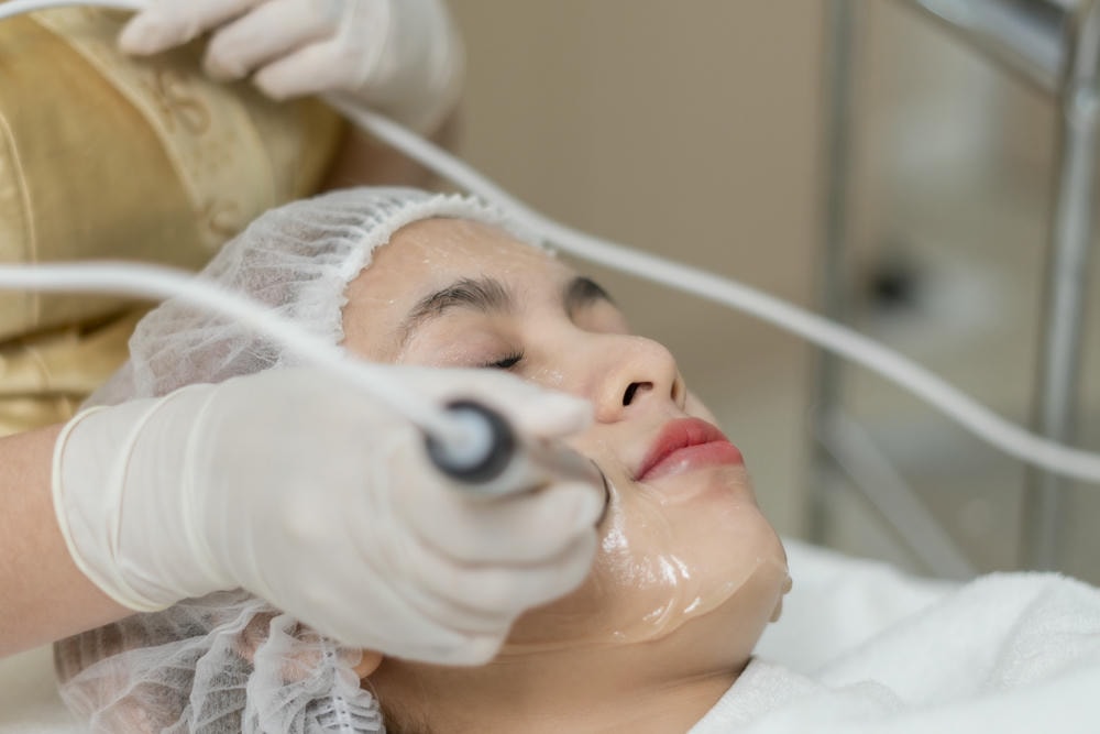 Bức ảnh cận cảnh thể hiện hiệu quả căng chỉ collagen rõ rệt, khẳng định căng chỉ collagen là lựa chọn an toàn theo nhận định của chuyên gia da liễu thẩm mỹ. 