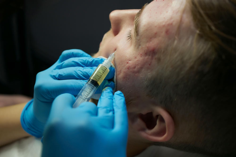 cắt đáy sẹo. Tiêm tại spa salon Bàn tay bác sĩ đeo găng tay Cận cảnh Bệnh nhân nam xinh đẹp Điều trị làm đẹp Thủ thuật da khỏe mạnh Mặt người đàn ông trẻ tuổi Trẻ hóa Plasmolifting