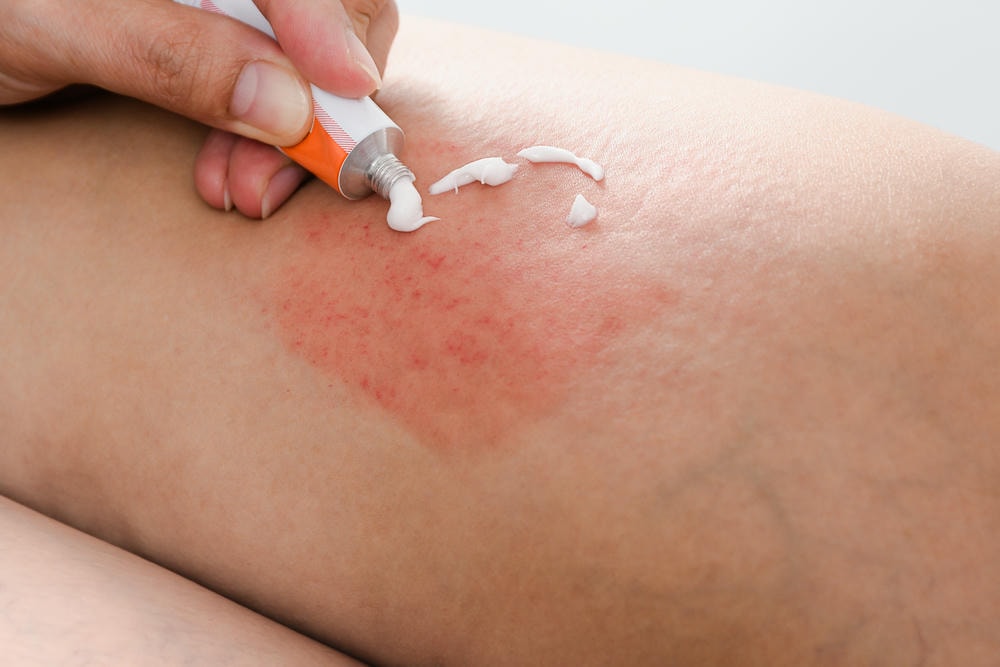 Bức ảnh corticoid bôi da được chụp với độ sắc nét cao, thể hiện cặn kẽ tác dụng corticoid bôi da trong việc cải thiện cấu trúc da, đồng thời phản ánh lợi ích corticoid bôi da thông qua cách sử dụng corticoid bôi da hợp lý để tránh các tác dụng phụ corticoid bôi da.