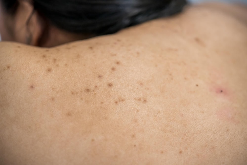 Dựa trên các đánh giá lâm sàng, da nổi đốm nâu không ngứa được xem như một biểu hiện của nguyên nhân da nổi đốm nâu liên quan đến sự tích tụ sắc tố, đòi hỏi cách điều trị đốm nâu trên da kịp thời cùng chăm sóc da bị đốm nâu và phòng ngừa đốm nâu trên da qua liệu pháp chuyên sâu.